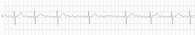 Atrial Fibrillation Rhythm Strip